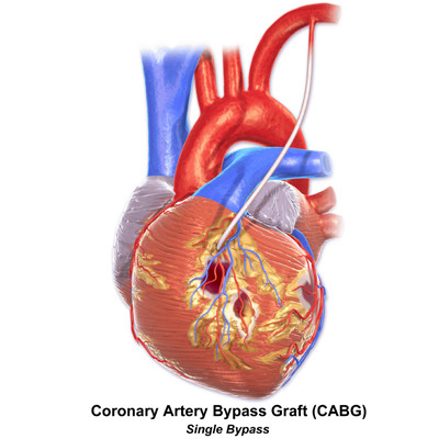 CABG (Coronary Artery Bypass Graft )-$5000