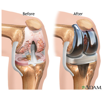 KNEE JOINT REPLACEMENT (CBMH)-$3000